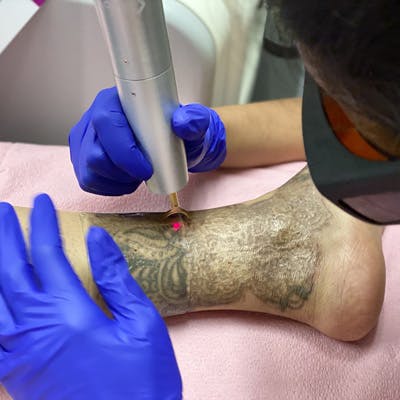 tattoo removal