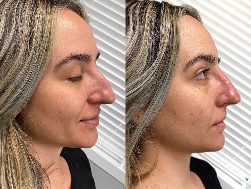 Non-surgical nose augmentation can transform minor structure issues.