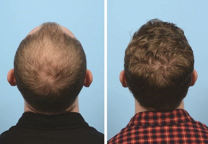 The FUE technique involves transplanting thousands of individual follicle units.