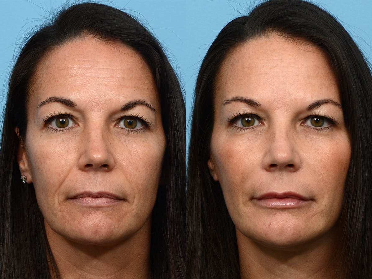 before and after facelift photo