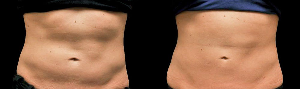 Before & After CoolSculpting