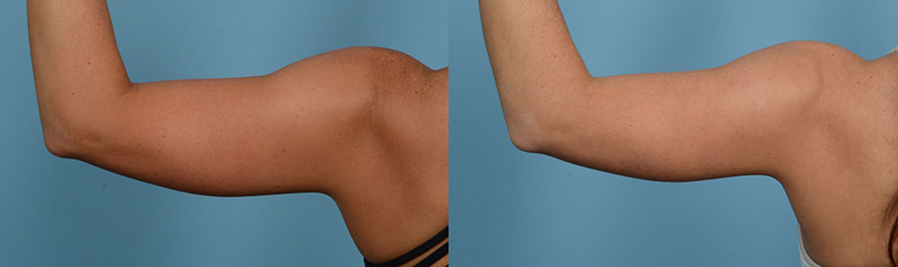 Before & After CoolSculpting