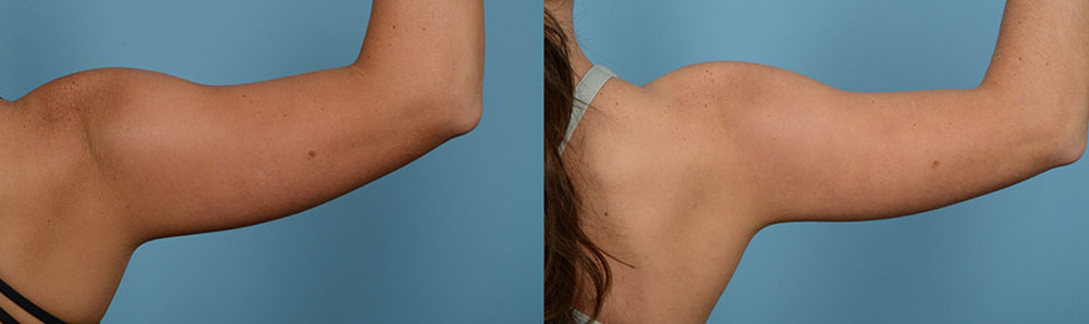 Before & After CoolSculpting