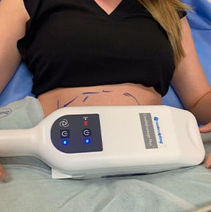 CoolSculpting device