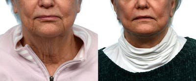 Facelift Before & After Gallery - Patient 258284 - Image 1