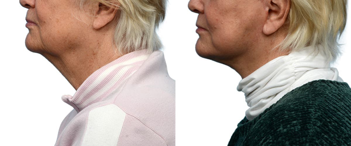 Facelift Before & After Gallery - Patient 258284 - Image 2