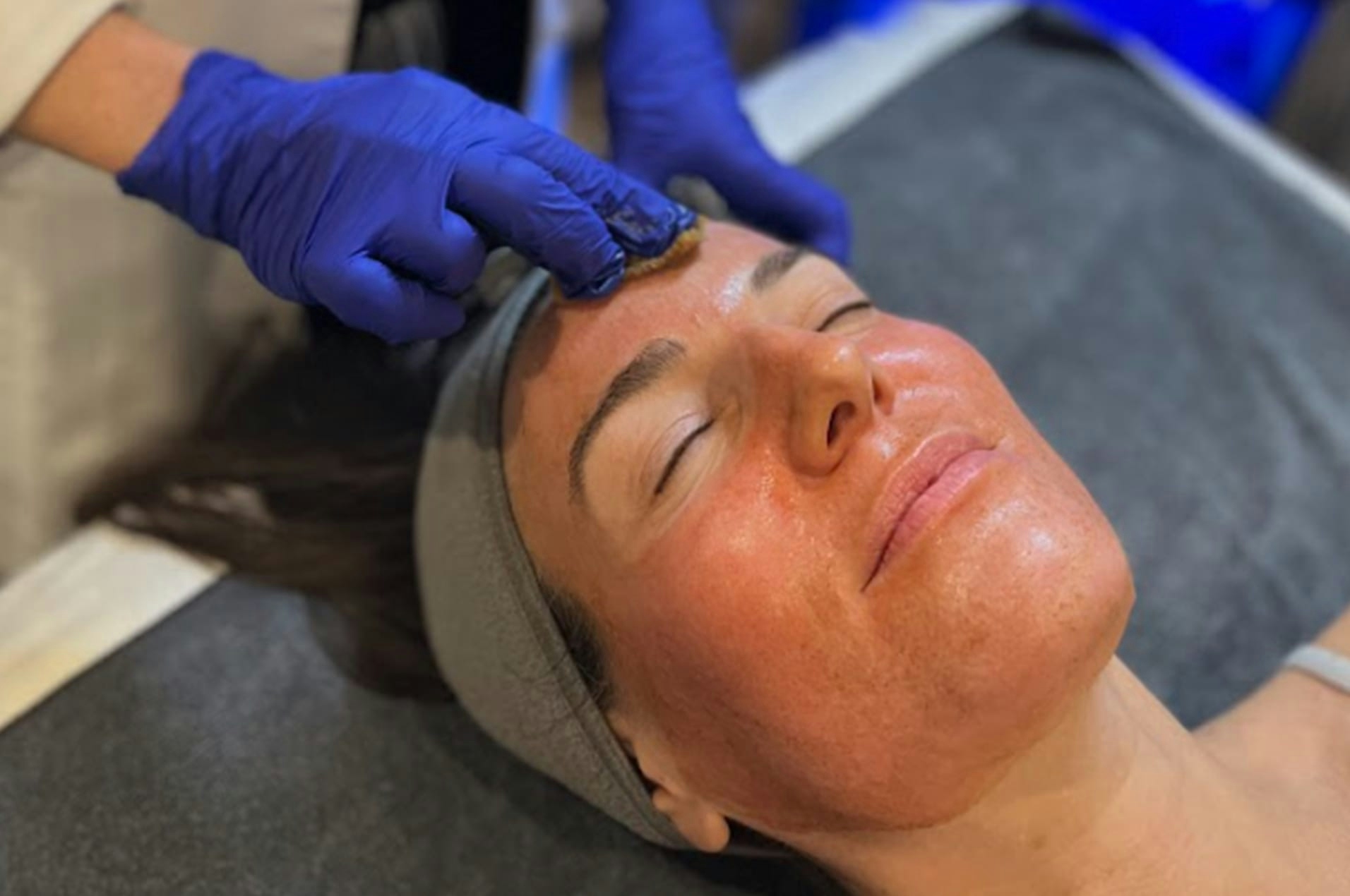 Woman receiving facial peel