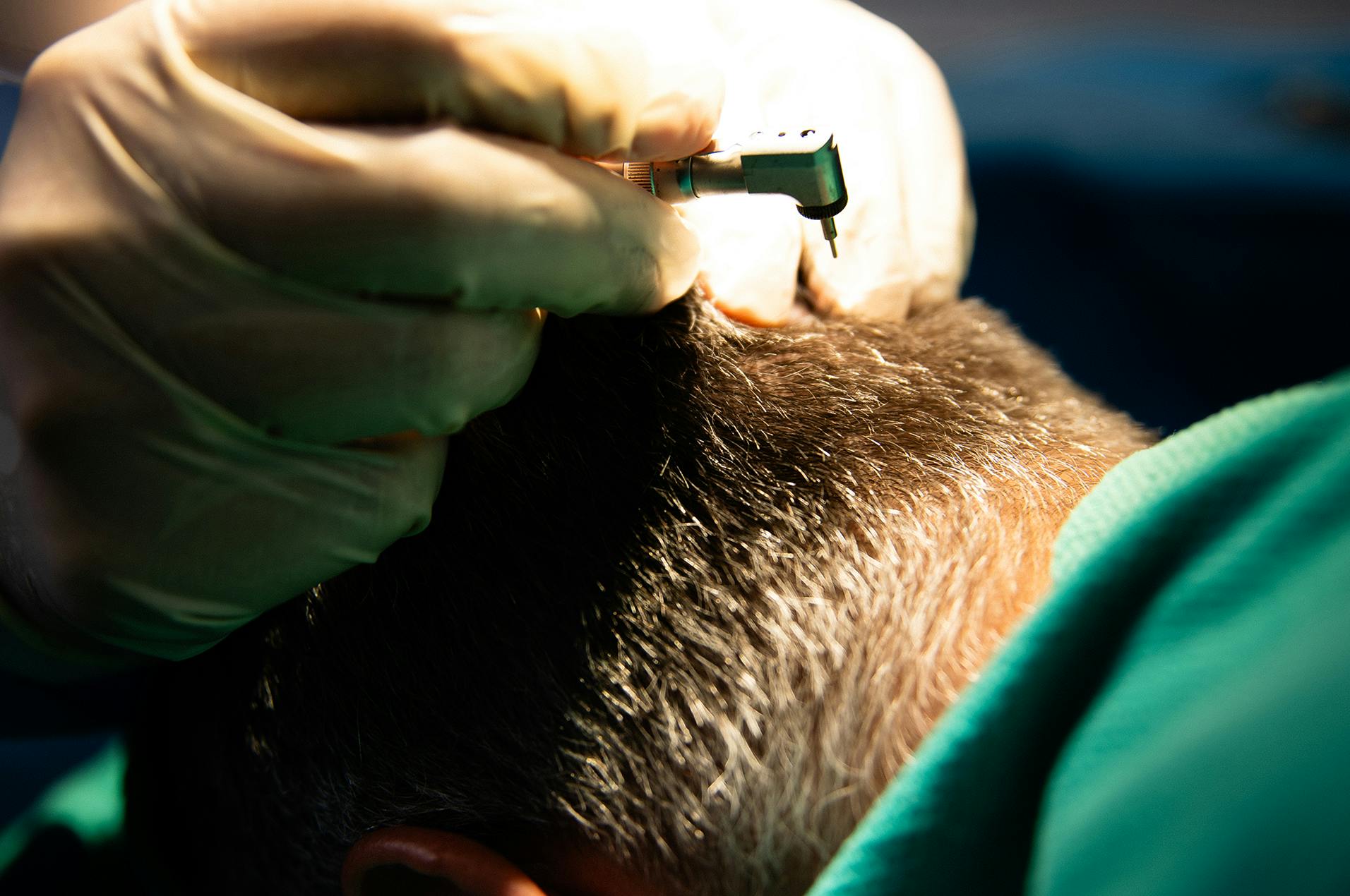 Man receiving hair restoration surgery