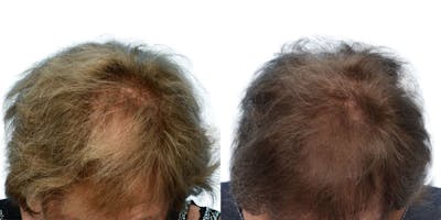 Platelet-Rich-Plasma Before & After Gallery - Patient 290649 - Image 1