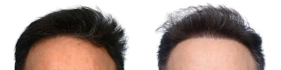FUE Hair Transplant Before & After Gallery - Patient 283150 - Image 1