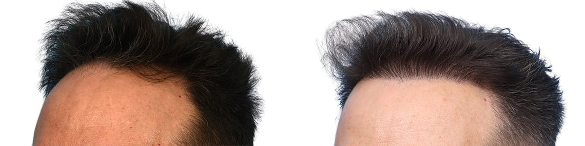 FUE Hair Transplant Before & After Gallery - Patient 283150 - Image 2
