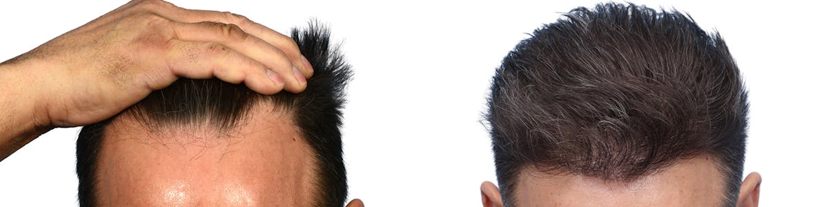 FUE Hair Transplant Before & After Gallery - Patient 283150 - Image 3