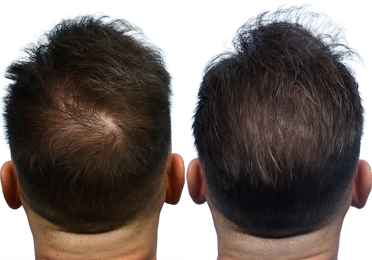 FUE Hair Transplant Before & After Gallery - Patient 283150 - Image 4