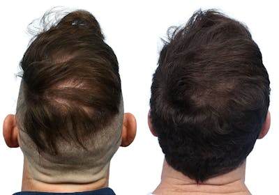 FUE Hair Transplant Before & After Gallery - Patient 275154 - Image 1
