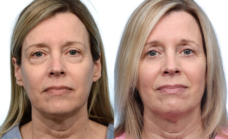 Blepharoplasty (Eyelid Surgery) Before & After Gallery - Patient 186603 - Image 1