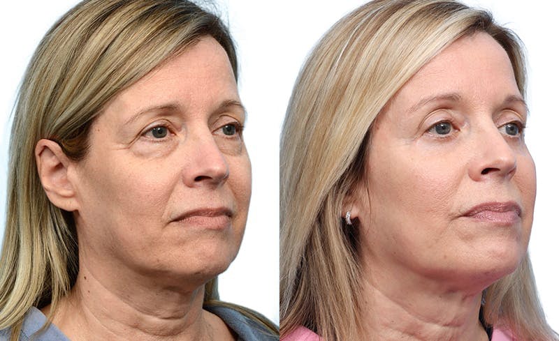 Blepharoplasty (Eyelid Surgery) Before & After Gallery - Patient 186603 - Image 2