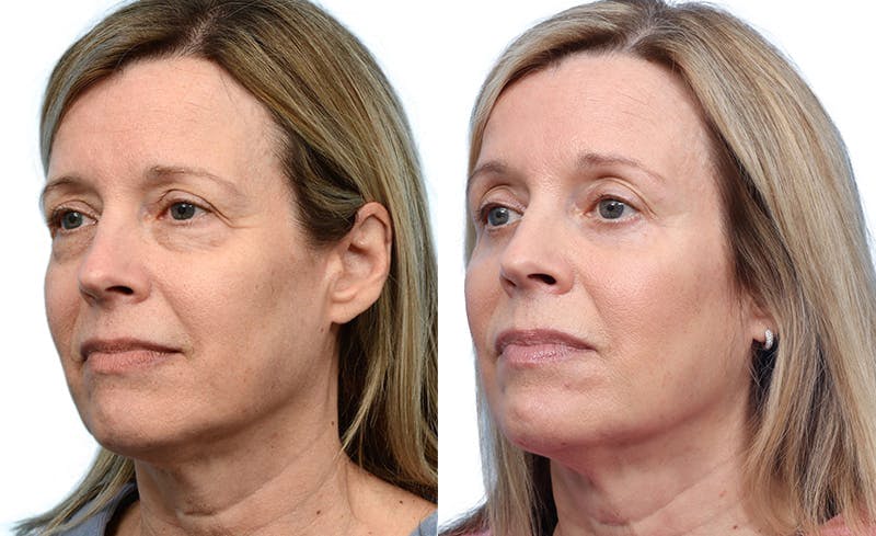 Blepharoplasty (Eyelid Surgery) Before & After Gallery - Patient 186603 - Image 3