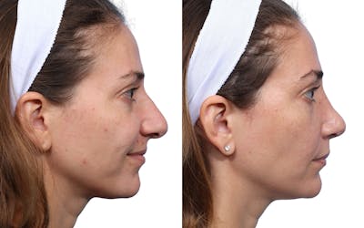 Rhinoplasty Before & After Gallery - Patient 251751 - Image 1