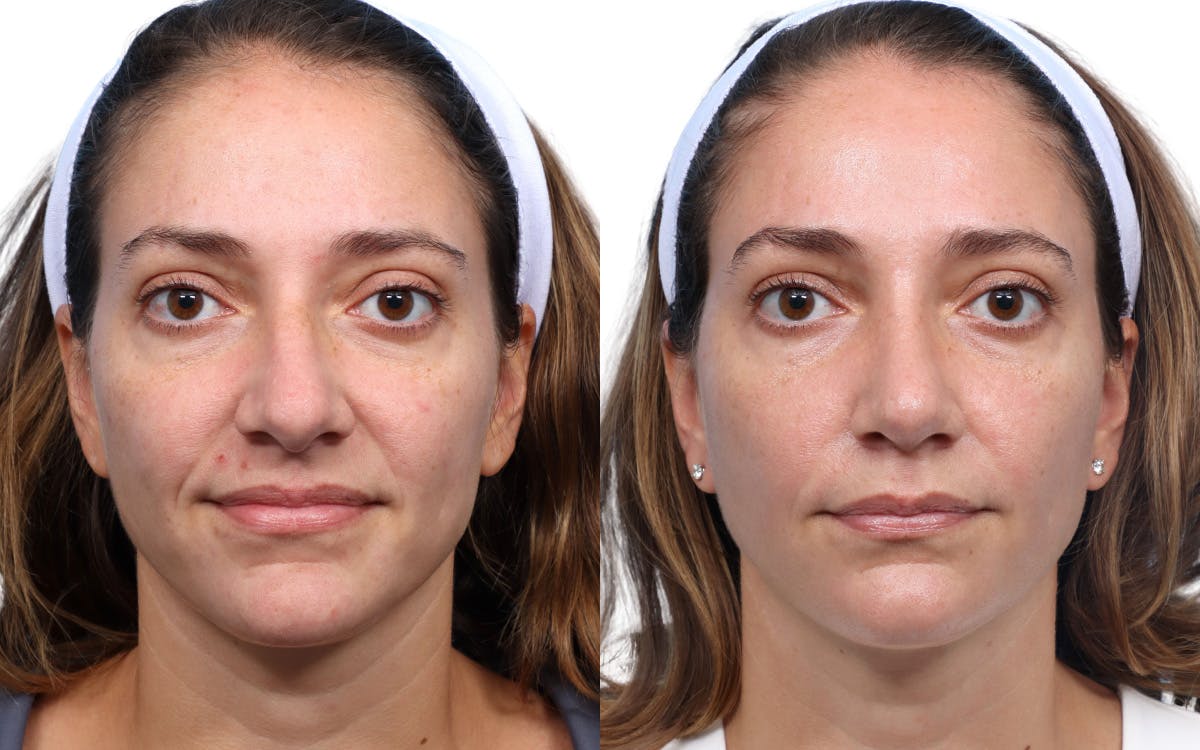 Rhinoplasty Before & After Gallery - Patient 251751 - Image 2