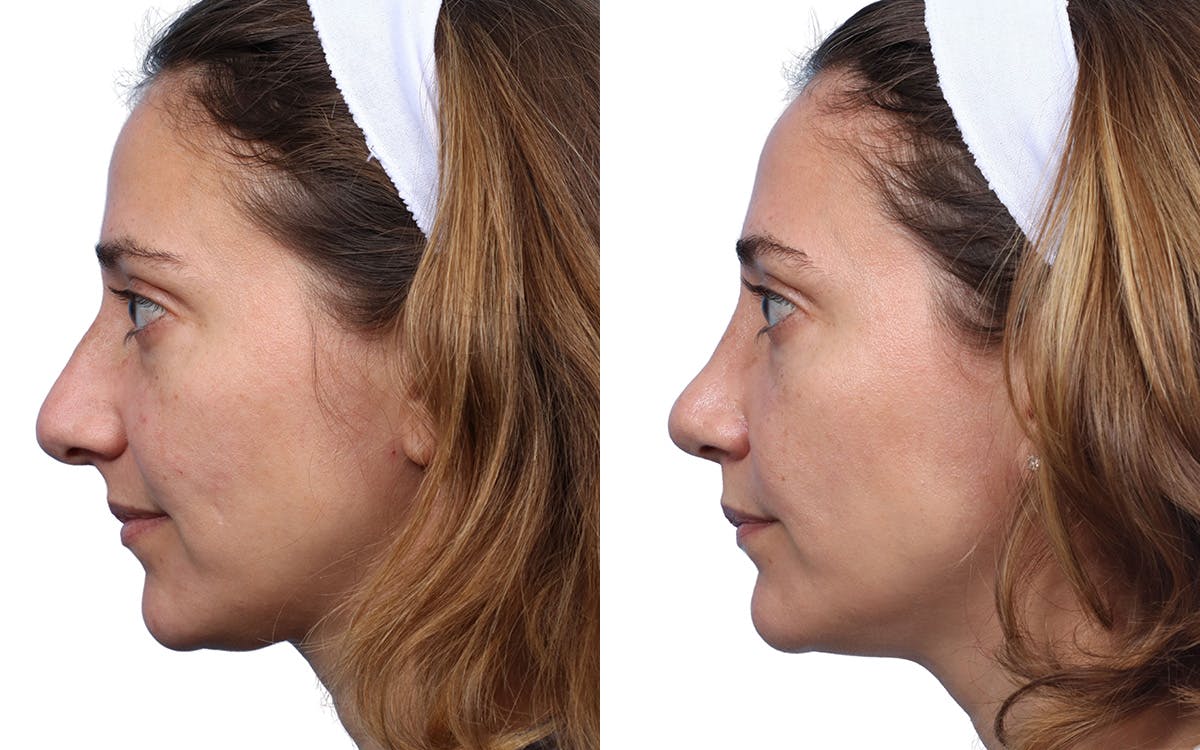 Rhinoplasty Before & After Gallery - Patient 251751 - Image 3