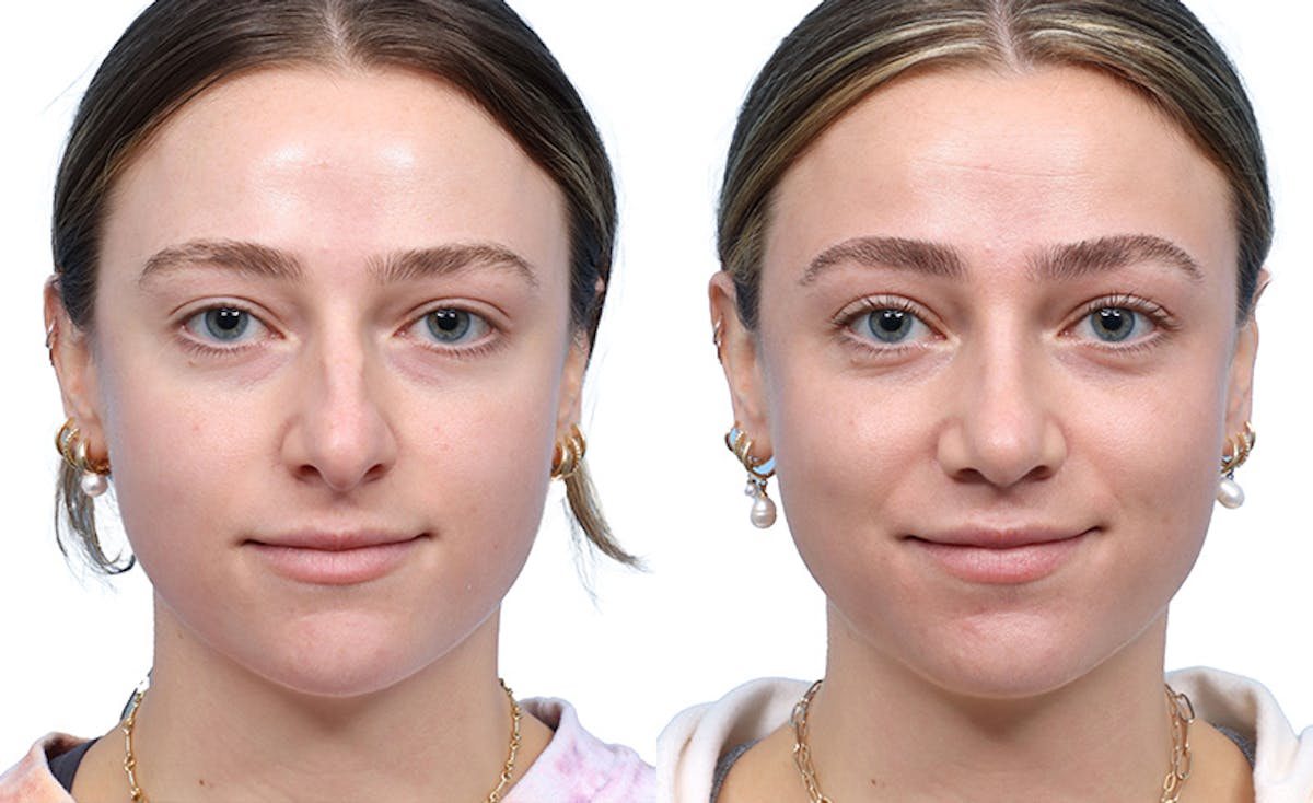 Rhinoplasty Before & After Gallery - Patient 222085 - Image 2