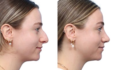 Rhinoplasty Before & After Gallery - Patient 222085 - Image 1