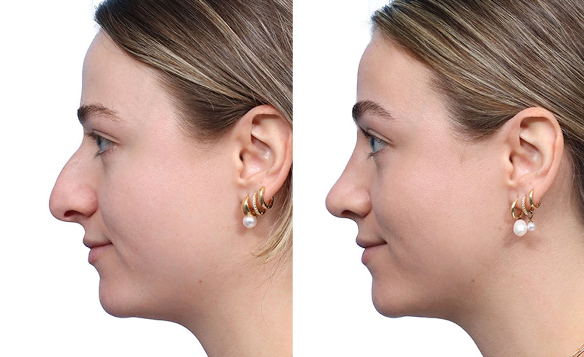 Rhinoplasty Before & After Gallery - Patient 222085 - Image 3