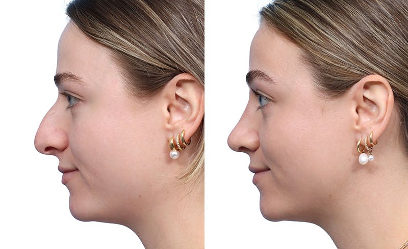 Rhinoplasty Before & After Gallery - Patient 222085 - Image 3