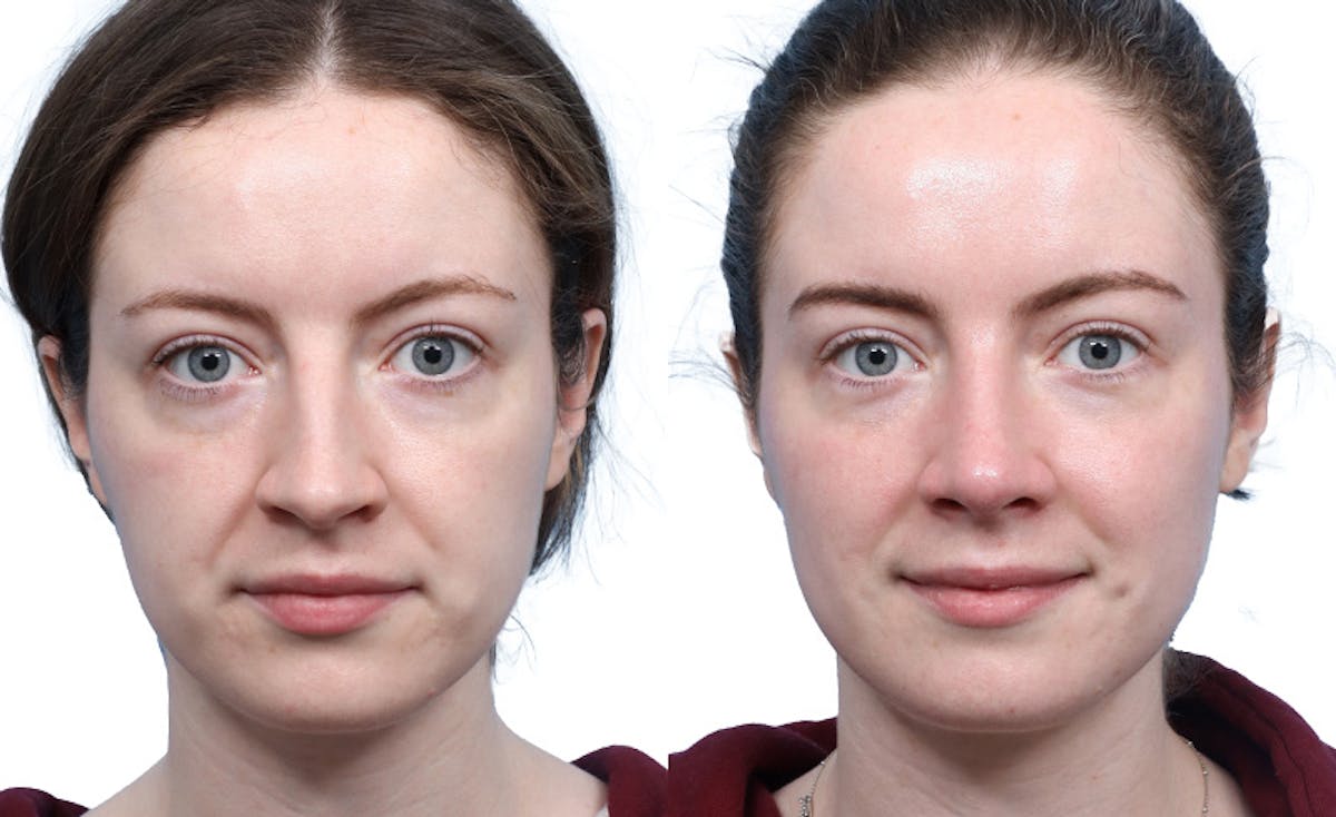 Rhinoplasty Before & After Gallery - Patient 189272 - Image 2