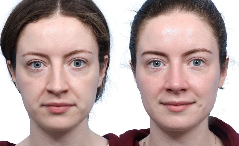 Rhinoplasty Before & After Gallery - Patient 189272 - Image 2