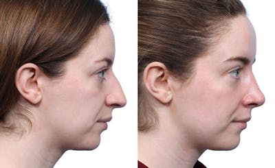Rhinoplasty Before & After Gallery - Patient 189272 - Image 1
