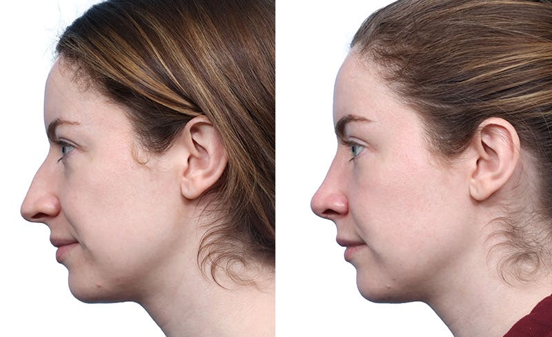Rhinoplasty Before & After Gallery - Patient 189272 - Image 3