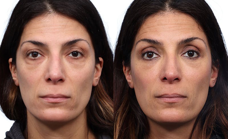 Blepharoplasty (Eyelid Surgery) Before & After Gallery - Patient 180218 - Image 1