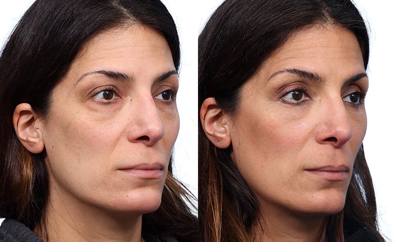 Blepharoplasty (Eyelid Surgery) Before & After Gallery - Patient 180218 - Image 2