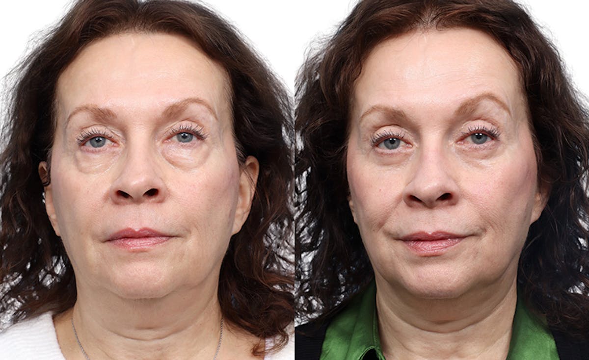 Blepharoplasty (Eyelid Surgery) Before & After Gallery - Patient 425125 - Image 1