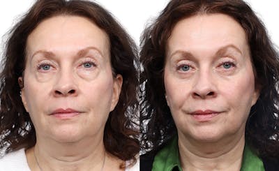 Blepharoplasty (Eyelid Surgery) Before & After Gallery - Patient 425125 - Image 1