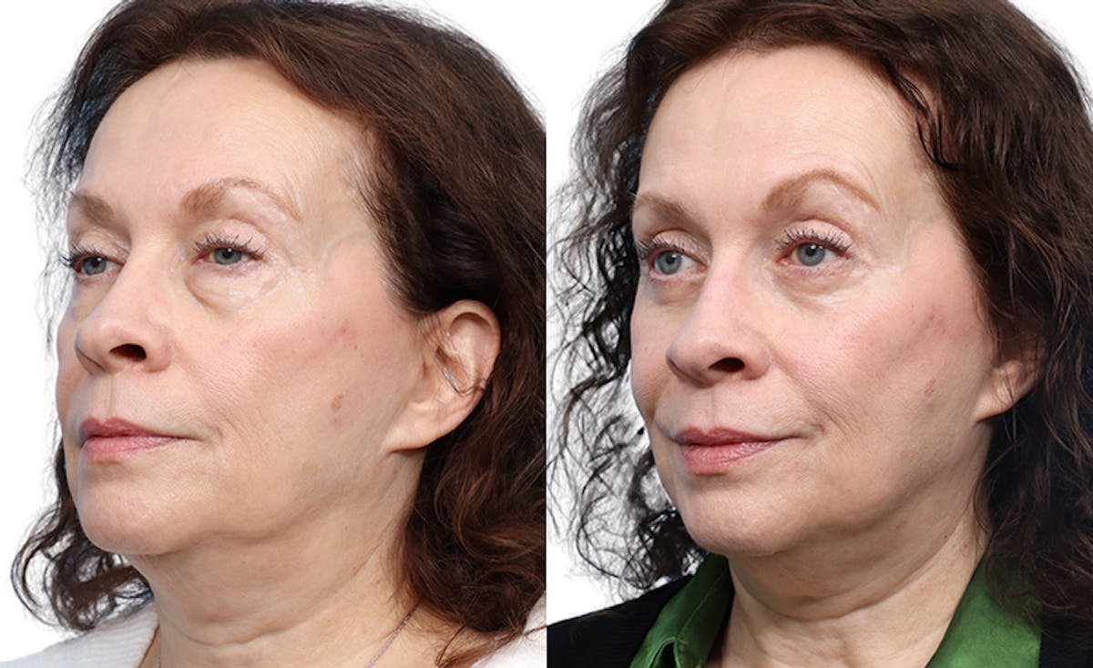 Blepharoplasty (Eyelid Surgery) Before & After Gallery - Patient 425125 - Image 2