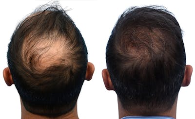 FUE Hair Transplant Before & After Gallery - Patient 296470 - Image 1