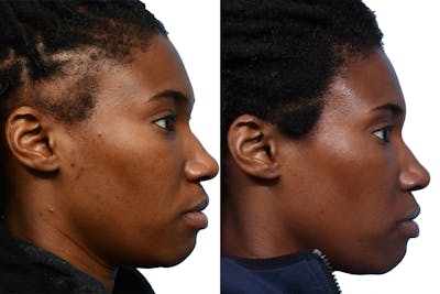 FUT Hair Transplant Before & After Gallery - Patient 381105 - Image 1