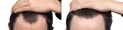 FUE Hair Transplant Before & After Gallery - Patient 467618 - Image 1
