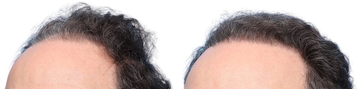 FUE Hair Transplant Before & After Gallery - Patient 173730 - Image 2