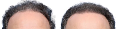 FUE Hair Transplant Before & After Gallery - Patient 173730 - Image 1