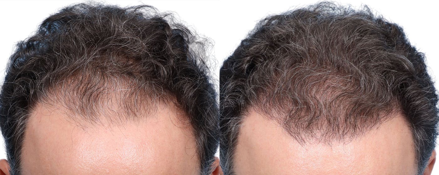 FUE Hair Transplant Before & After Gallery - Patient 173730 - Image 3