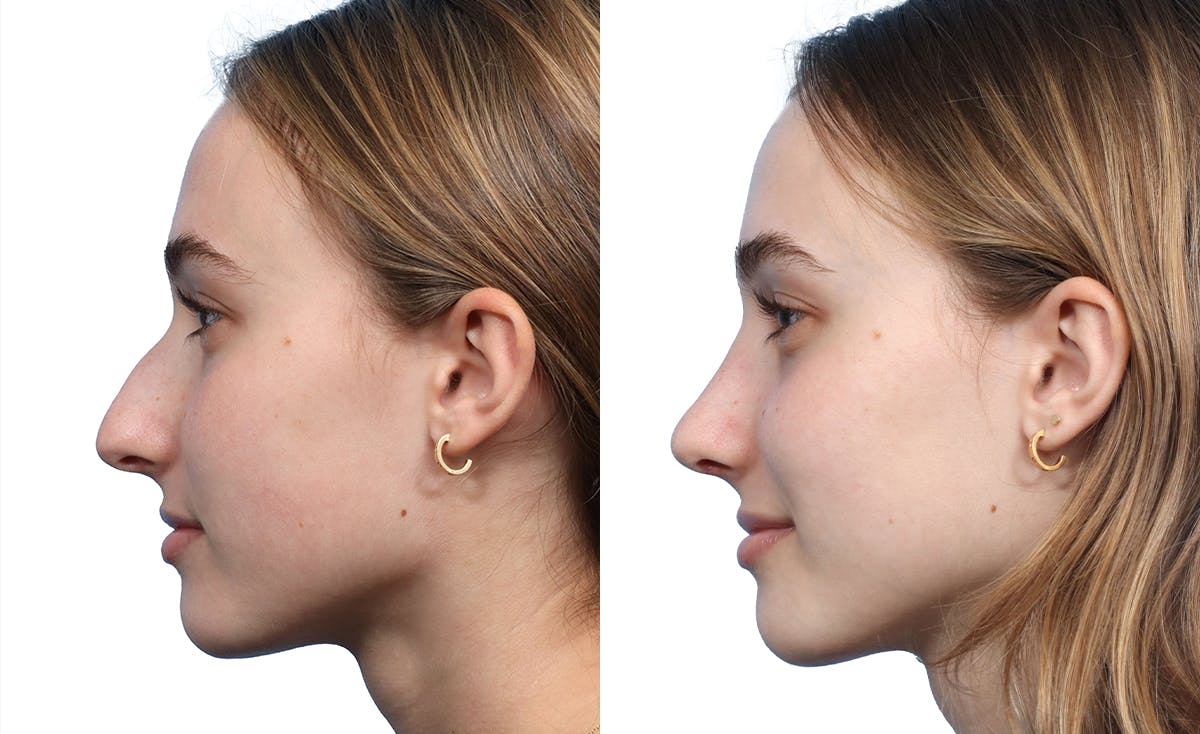 Rhinoplasty Before & After Gallery - Patient 327524 - Image 2