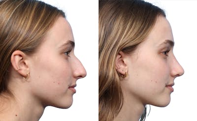Rhinoplasty Before & After Gallery - Patient 327524 - Image 1