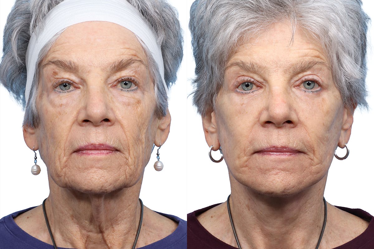 Facelift Before & After Gallery - Patient 225528 - Image 1