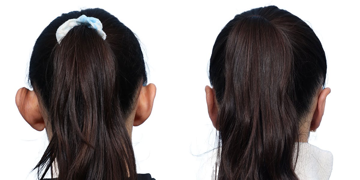 Otoplasty (Ear Surgery) Before & After Gallery - Patient 844496 - Image 2