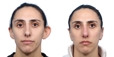 Otoplasty (Ear Surgery) Before & After Gallery - Patient 844496 - Image 1