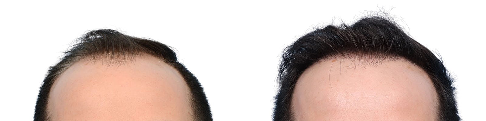 FUE Hair Transplant Before & After Gallery - Patient 427638 - Image 1
