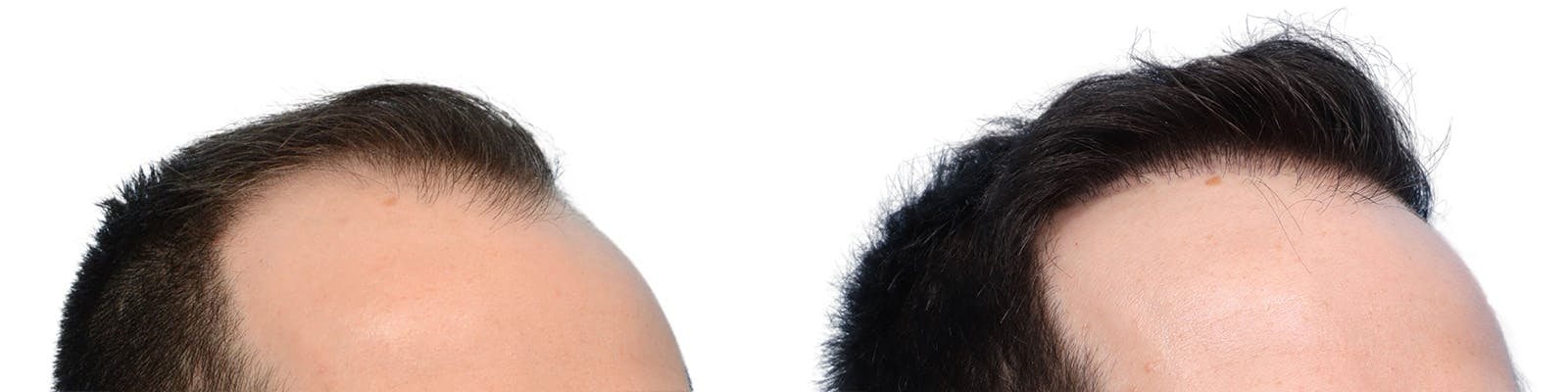 FUE Hair Transplant Before & After Gallery - Patient 427638 - Image 2
